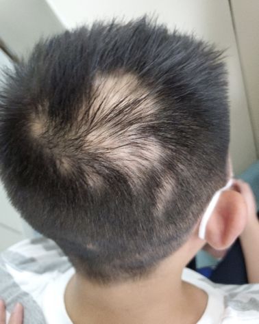 高考临近母子连心杭州一考生和妈妈同时患上斑秃