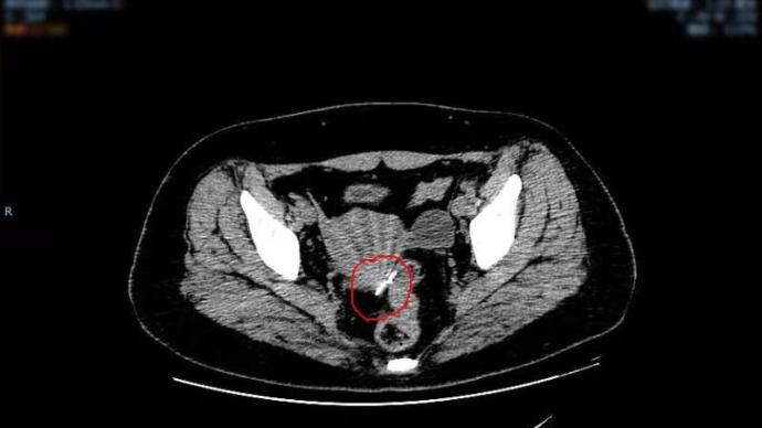 女子腹内藏针30年无感，取出时已游走至盆腔且腐蚀严重