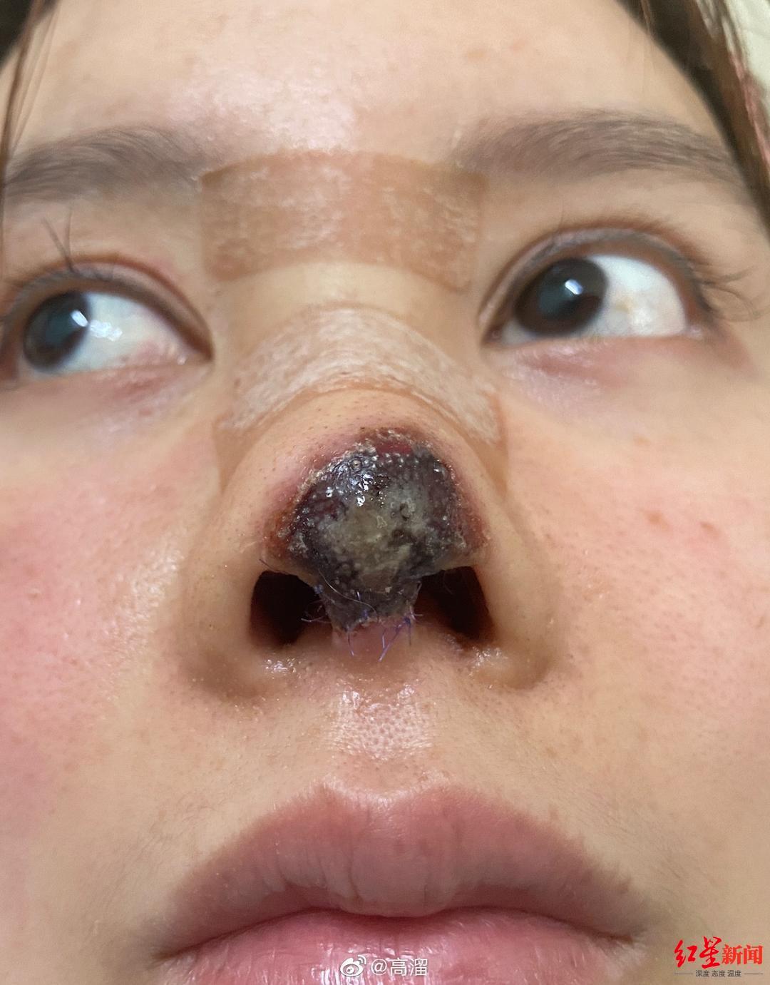 鼻子座疮造成的痘坑痘疤 激光和手术切除经历 - 知乎