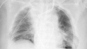 日本完成新冠肺炎患者活体肺移植手术，系世界首例