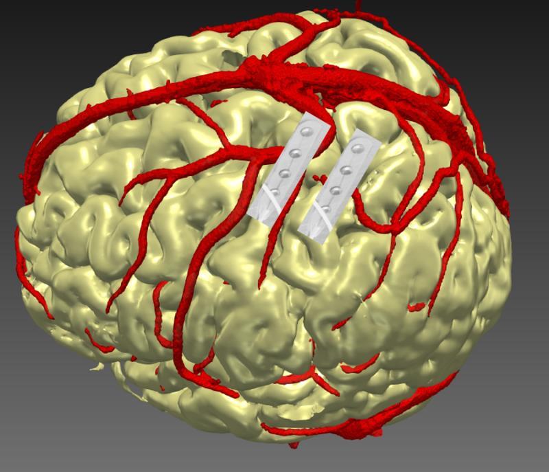 首款闭环神经刺激器在脑部安装的示意图