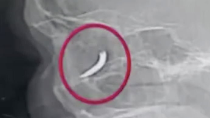 铁钉扎入工人眼眶,3天后才被发现