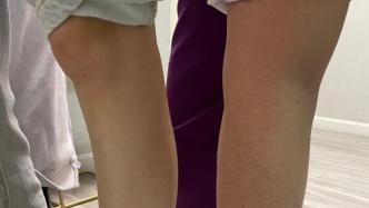 80多斤女孩要吸脂瘦腿被医生劝退：我的前臂都比你小腿粗