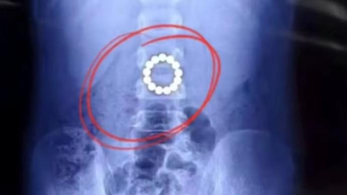 胃壁穿孔！4岁男童吞13颗磁力珠胃内连成串