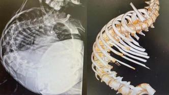 13岁女孩脊柱侧弯176度说话不成句，在上海接受矫治手术