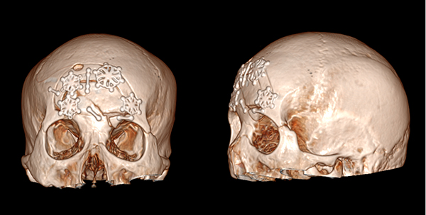 手术后,医生用金属连接并固定患者额头的碎骨片.