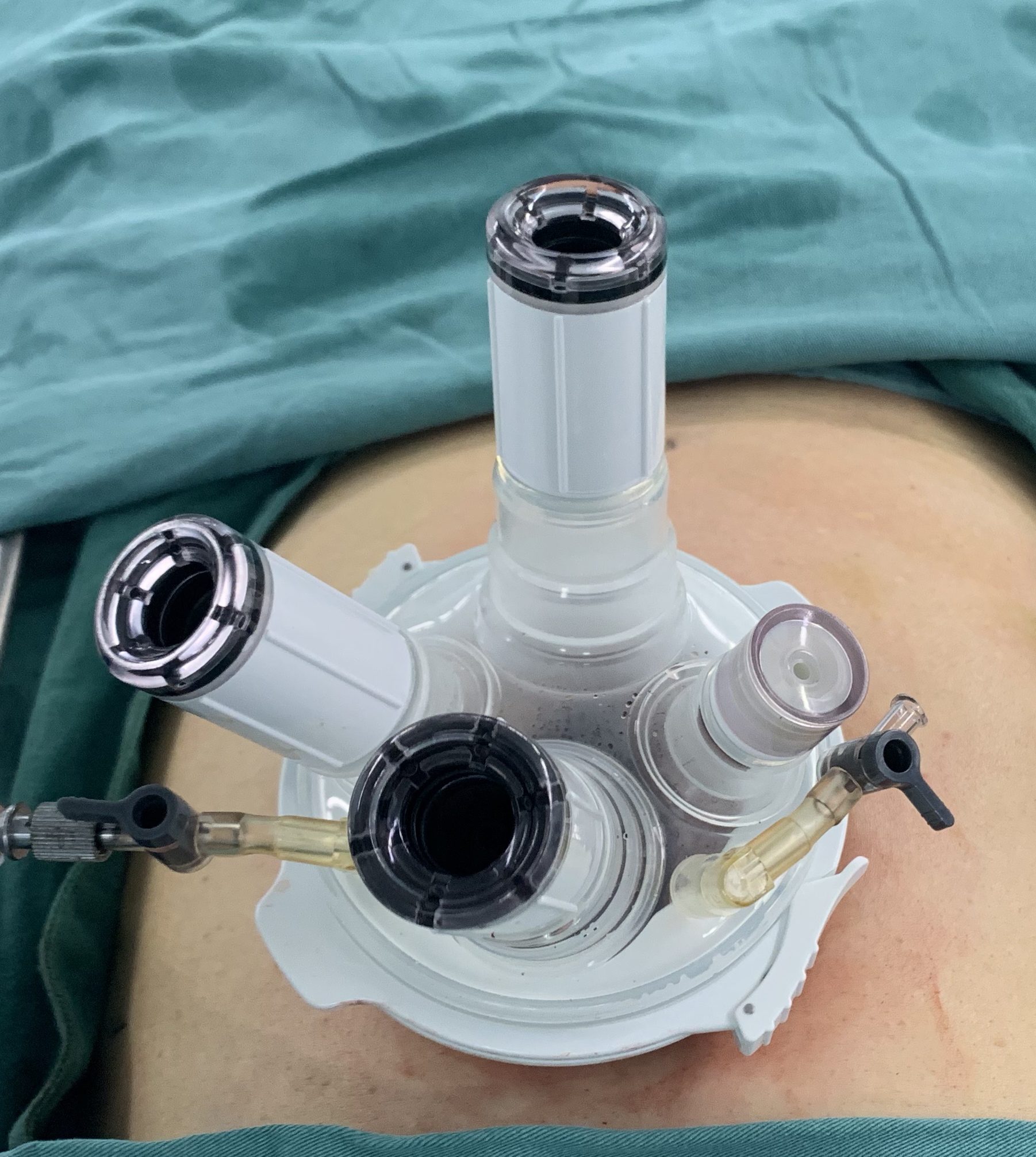 第四代达芬奇机器人辅助单孔结直肠癌根治术只需在患者脐部切开一个4厘米的小口子。 