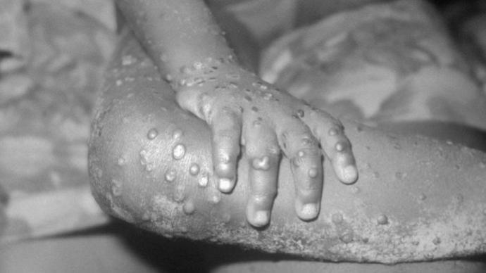 从尼日利亚返美公民染猴痘，CDC紧急监测百名关联人员