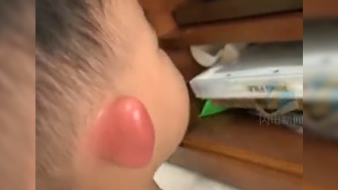 萌娃耳朵被蚊虫叮咬，肿成“大耳朵图图”