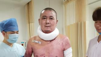 杭州电瓶车爆燃烧伤父女最新情况：父亲出院，女儿仍在抗感染