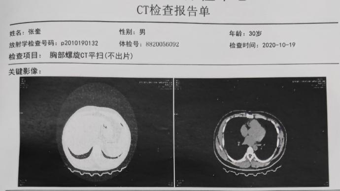 杭州一除甲醛公司员工称对公司药水过敏，20人查出肺结节