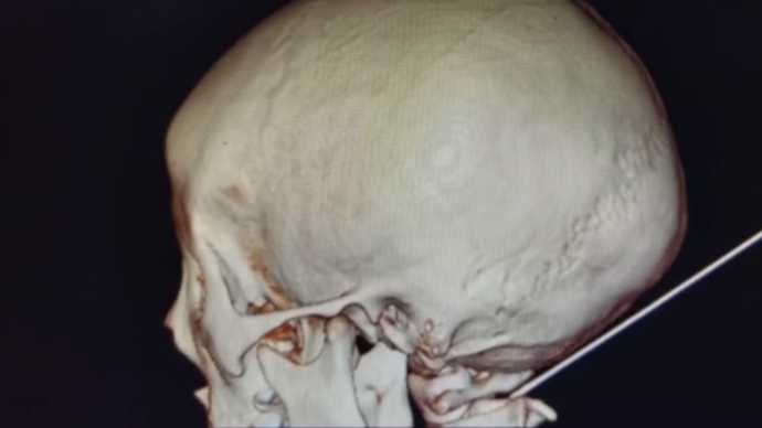 父亲动手训娃，男童意外被铅笔戳入后脑勺7厘米