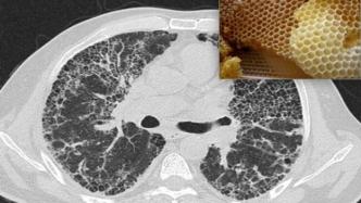 罕见病科普｜肺相关罕见病：不明“蜂窝肺”以及硬皮病伴发肺纤维化