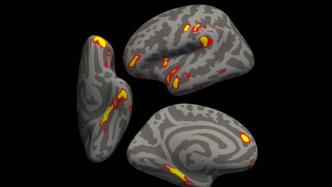牛津大学研究：感染新冠或致脑受损，增加罹患阿兹海默症可能性