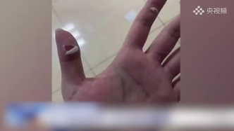 一名上海抗疫者的手：拧开两千个核酸采样管后手破皮