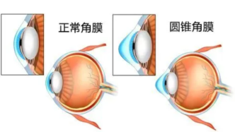 圆锥角膜病患福音！上海这项新研究有望提供更安全有效的策略