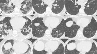 奥地利新研究提示：新冠肺炎后很长时间内仍可观察到肺部异常