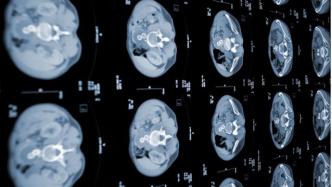 一眼扫描4000种不同特征，AI提前预测胰腺癌提高存活率