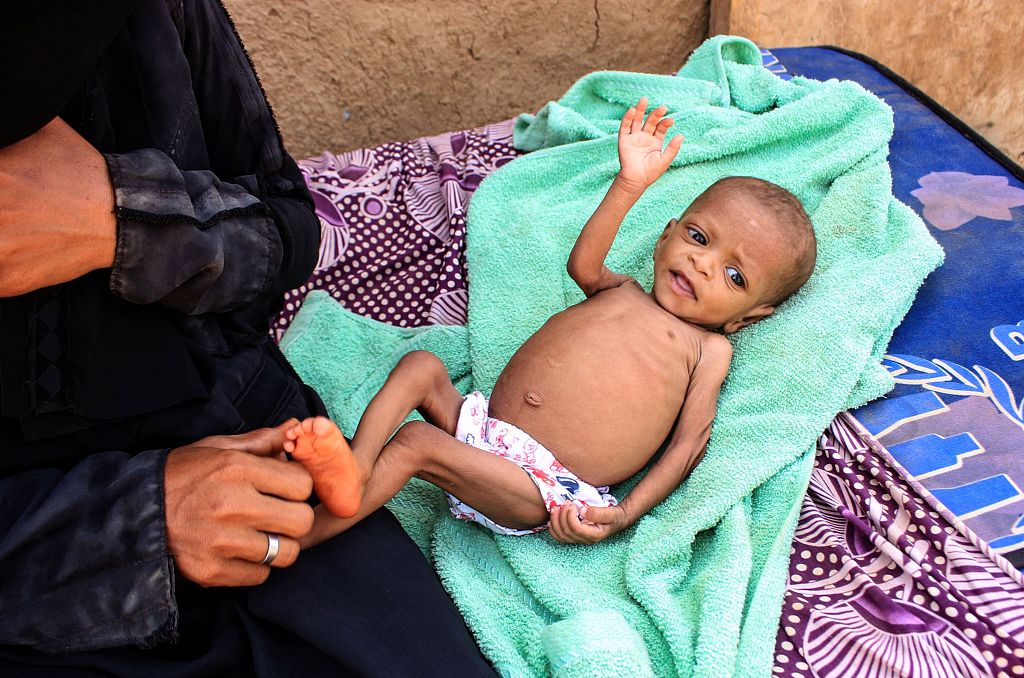 当地时间2022年5月14日，也门北部哈杰省，1岁半的孩子面临严重营养不良问题，在流浪者临时营地居住。