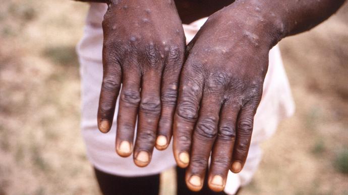 世卫：今年以来刚果（金）1200多人疑似感染猴痘