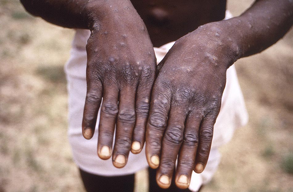 美国疾病控制与预防中心提供的图像：1997年，刚果（金），显示一位猴痘患者手部。  视觉中国 图 