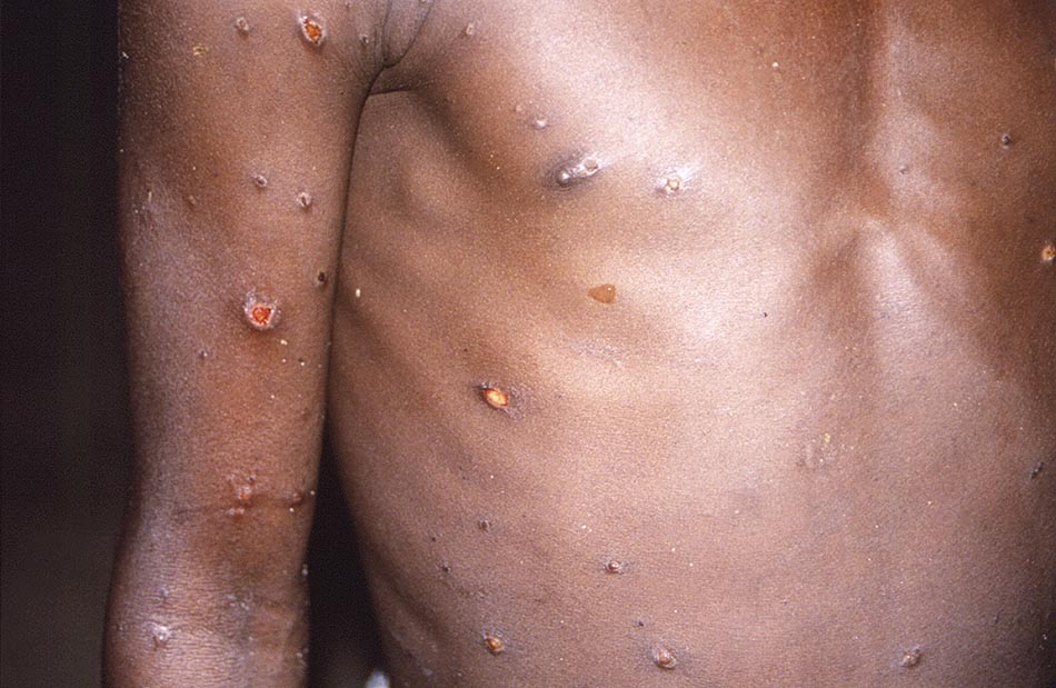 美国疾病控制与预防中心提供的这张1997年图像，显示一位猴痘患者的皮肤损伤。视觉中国 图