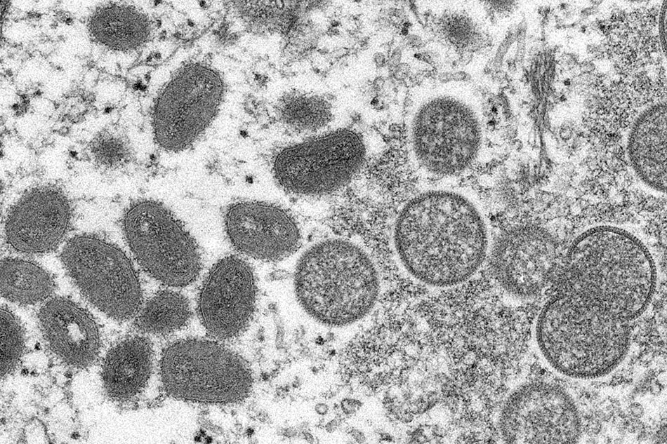 猴痘病毒显微镜图像：成熟的椭圆形猴痘病毒粒子(左)和球形未成熟病毒粒子(右)。这些病毒粒子来自与2003年草原犬鼠传染病暴发相关的人类皮肤样本。（资料图）