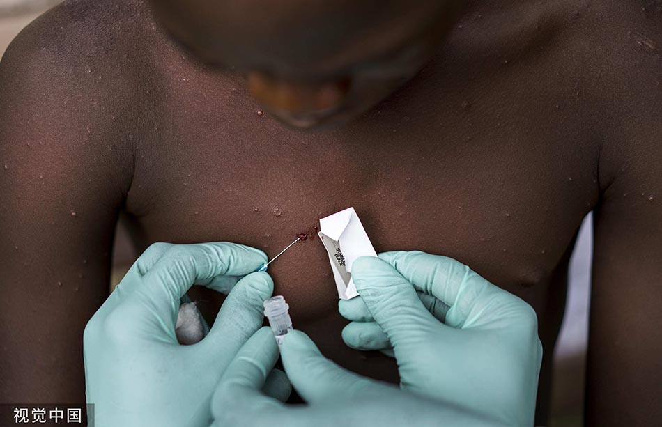 当地时间2017年8月29日，刚果（布），医生正在对一名疑似感染猴痘病毒的男孩进行检查。人民视觉 图
