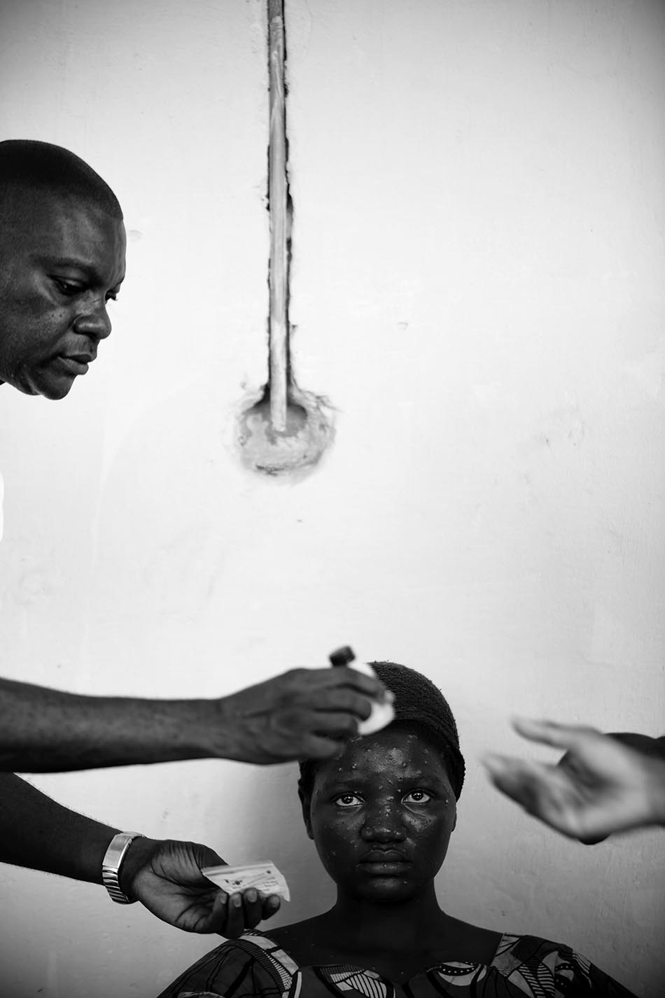 2008年6月，刚果（金），一位猴痘患者。人民视觉 图