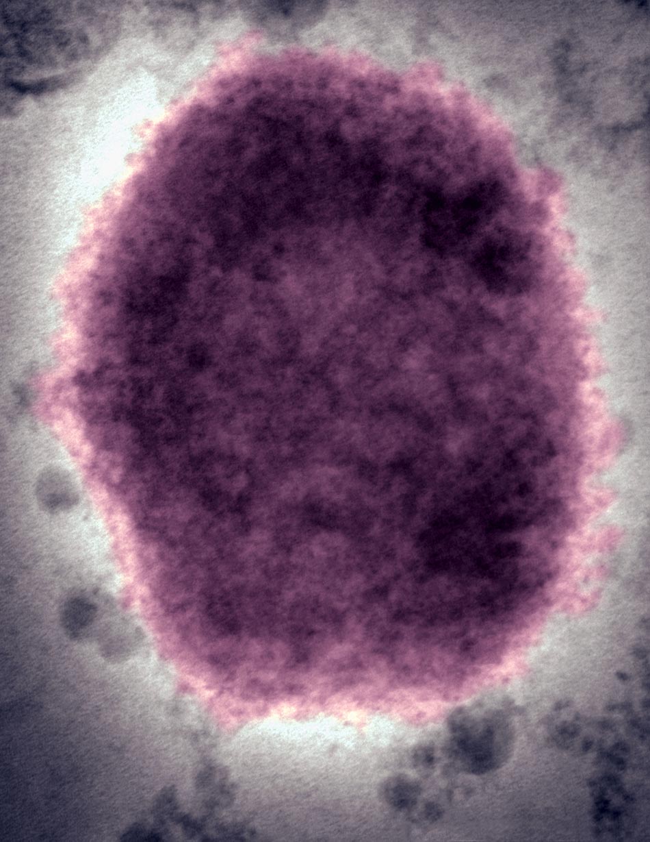 2005年8月18日，水泡性皮疹中存在的猴痘病毒。