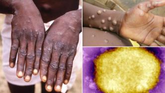 世卫组织：猴痘对全球公共卫生构成“中等风险”