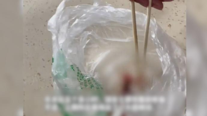 女子人流術后腹痛排出一團棉球,病人質疑醫生手術太粗心