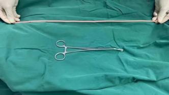 温州一男孩将一米半长跳绳塞进尿道，医生在膀胱打孔取出