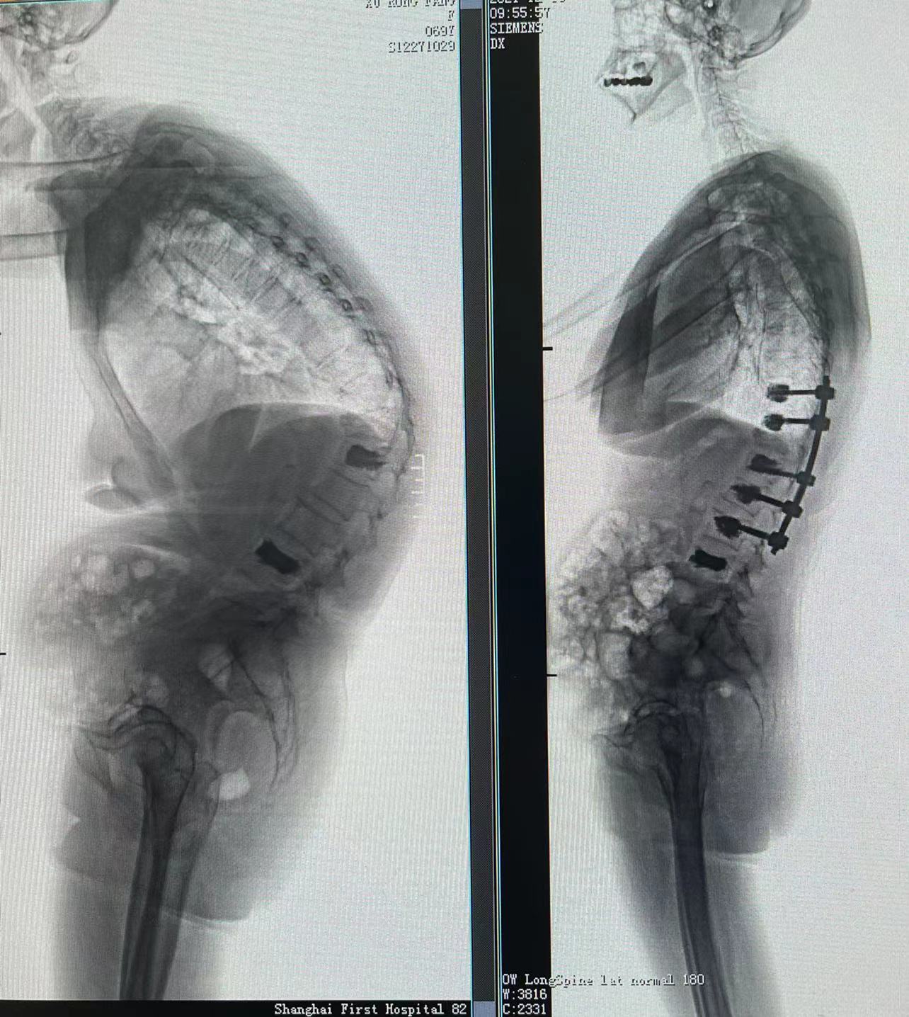 脊柱畸形的X线摄片方法，看完这篇你就掌握！ - 好医术早读文章 - 好医术-赋能医生守护生命