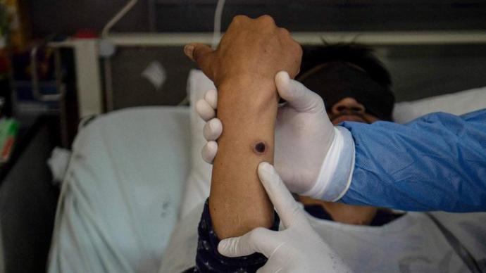 早安·世界｜全球猴痘病例报告一周增加20%，已超3.5万