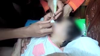 幼童被指甲刀夹住嘴唇，消防医生联合救助
