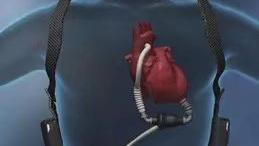世界心脏日｜“人工心脏”可以令患者“起死回生”吗？