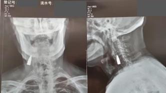 95岁老兵拍X光发现颈部有子弹头，家人：抗日战争留下的