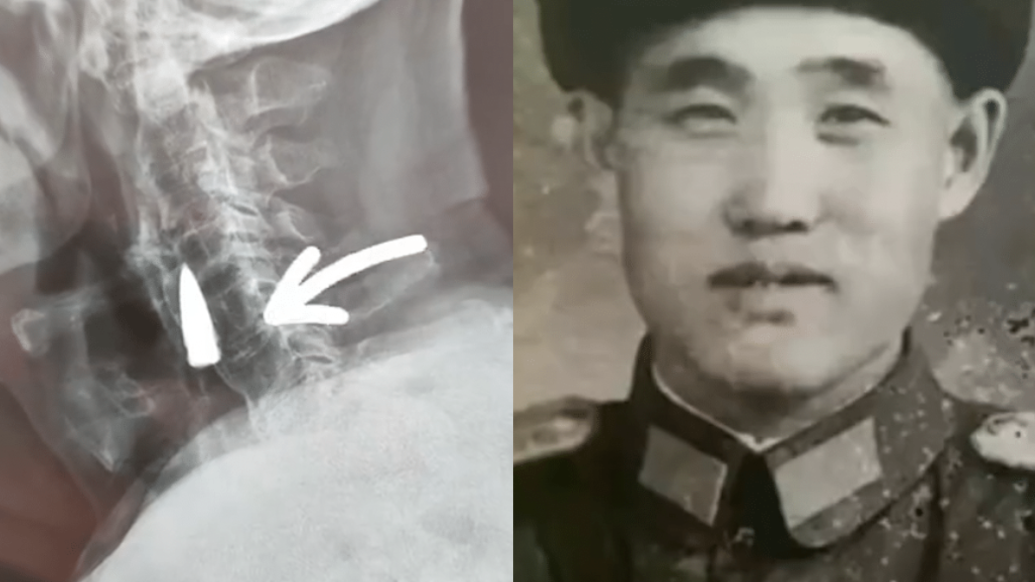 95岁老战士颈部发现子弹：背受伤战友过河时受伤