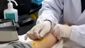杭州医生扎针似飞针，被赞“蚊子投胎”