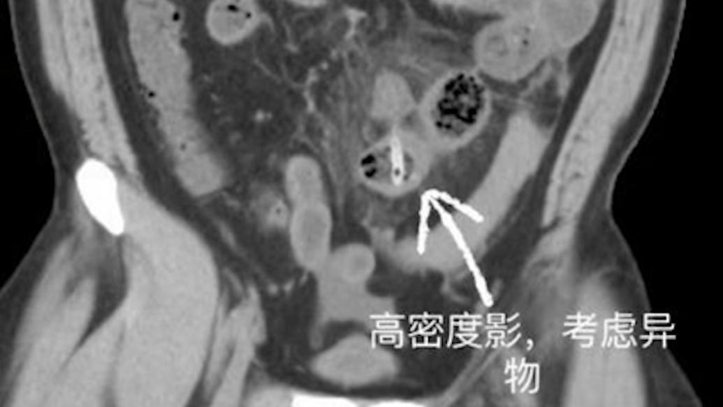 男子“囫囵吞枣”2天后腹痛，检查发现为肠穿孔