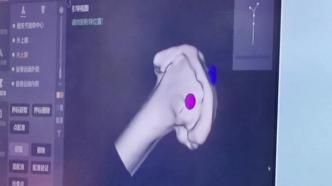 全国首台国产机器人膝关节置换术在四川成功开展