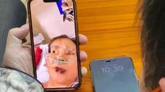 上海62岁阿姨为穿旗袍抽脂感染住进ICU，6次手术保住命