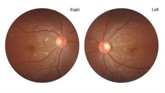 20岁女孩感染新冠3天后几近失明，确诊视网膜病变