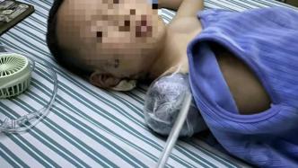 江西7岁男童遭邻居炮仗炸伤手臂截肢，当地警方：已展开侦查