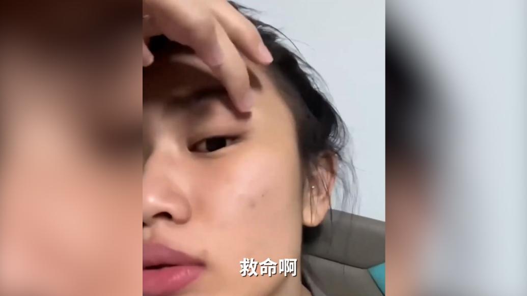 女子卸妆时未摘，美瞳跑到眼球后