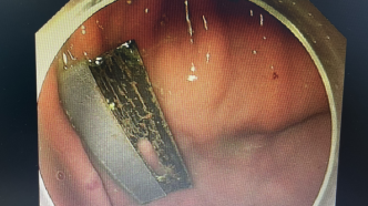 病人吞下刀片，医生用避孕套成功取出