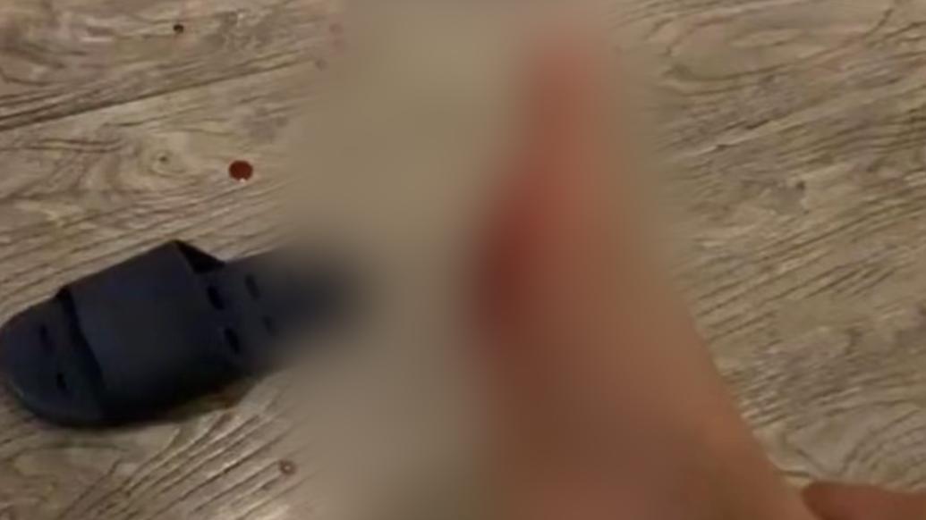 女子入住酒店穿拖鞋被內藏刀片劃傷,向酒店索賠遭拒絕