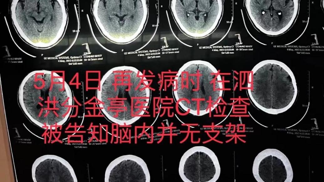宿迁一患者因脑梗去世，医生承认此前未成功植入脑血管支架并隐瞒