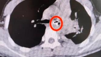 小学生咳嗽发烧8天，检查发现气管内有一个“铅笔帽”